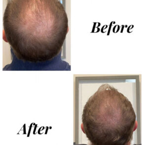 Scalp micropigmentation before and after on a thinning crown