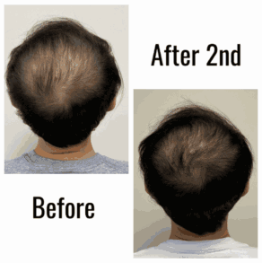 Scalp micropigmentation before and after a second session