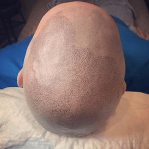 Top of a shaved head showing scalp micropigmentation